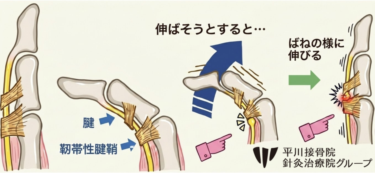 ばね指の解説