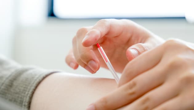 トリガーポイント鍼治療