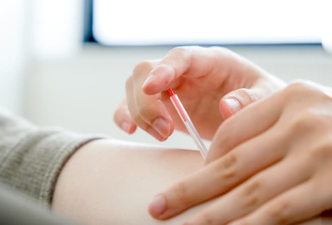 トリガーポイント鍼治療