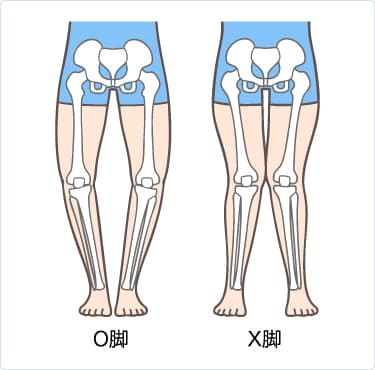 変形性膝関節症