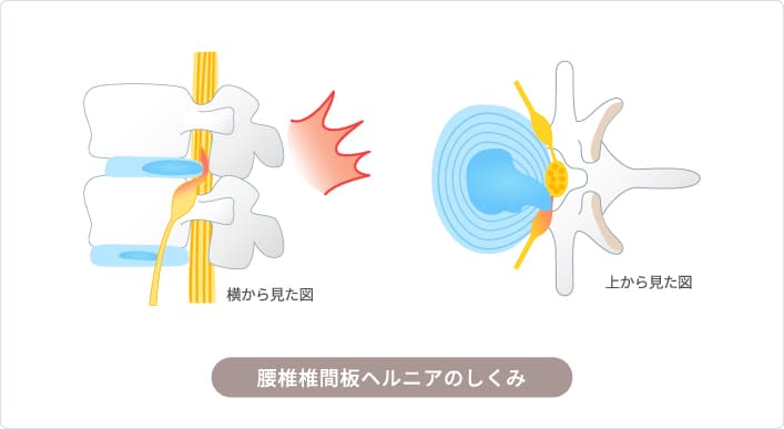 腰椎椎間板ヘルニア