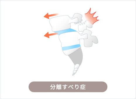 腰椎分離症・分離すべり症