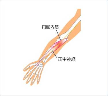 円回内筋症候群