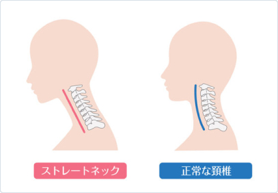 ストレートネック