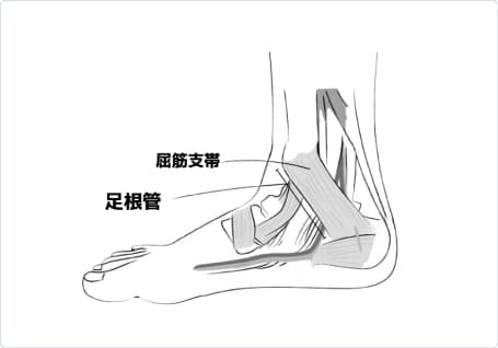 足根管症候群