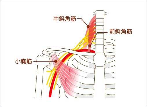 胸郭出口症候群