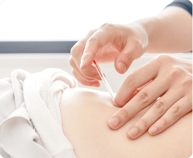 TRIGGER POINT RESET ACUPUNCTURE